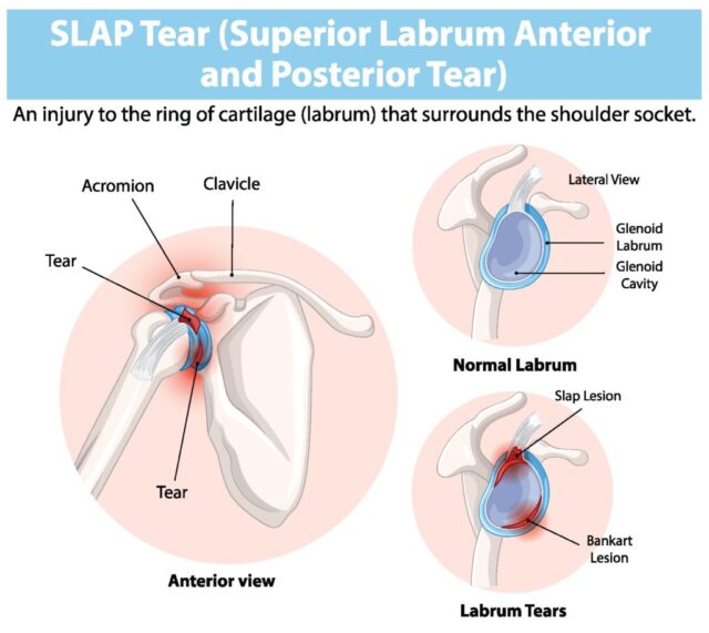 Shoulder Labral Injury