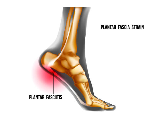 Plantar fasciitis 