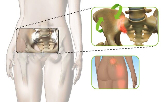Sacroiliac Joint Pain